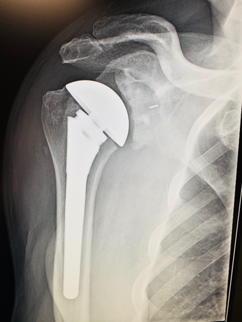 Total Shoulder Replacement